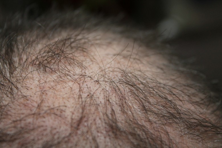 5 Proven Ways To Reverse Hair Loss Brass Kangaroo