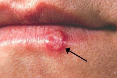 Lysine for Cold Sores - How Do I Use It For My Cold Sore?