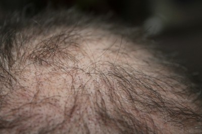  5 Proven Ways to Reverse Hair Loss